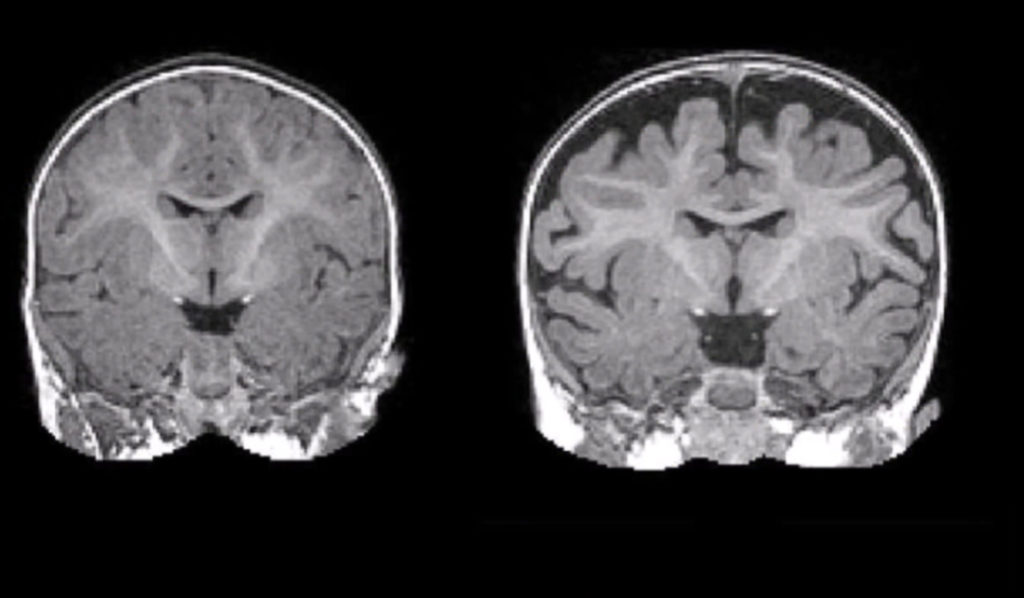 Một điều khá trùng hợp là sau khi chết, não của Lý Tiểu Long to hơn người bình thường 175g.